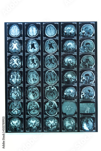 A snapshot of an elderly person's brain scan on magnetic resonance imaging MRI film, for neurological medical diagnosis of brain diseases