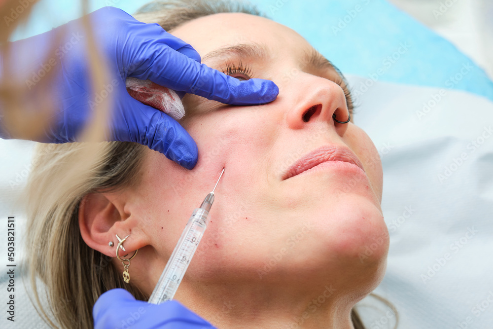 facial lifting with hyaluronic acid applied with a cannula facial lifting with hyaluronic acid applied with a cannula