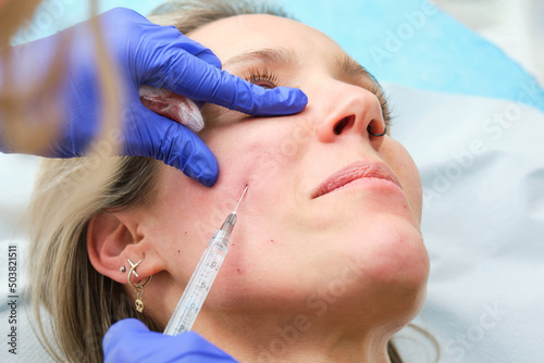 facial lifting with hyaluronic acid applied with a cannula photo