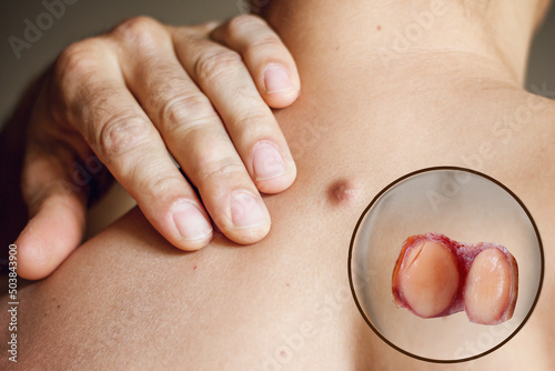 Fibroma on the male back, details, close-up, micro