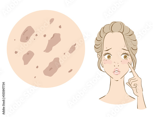 しみそばかすにに悩む可愛い女性
