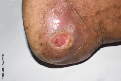 Diabetes foot ulcer in foot of Asian patient. photo