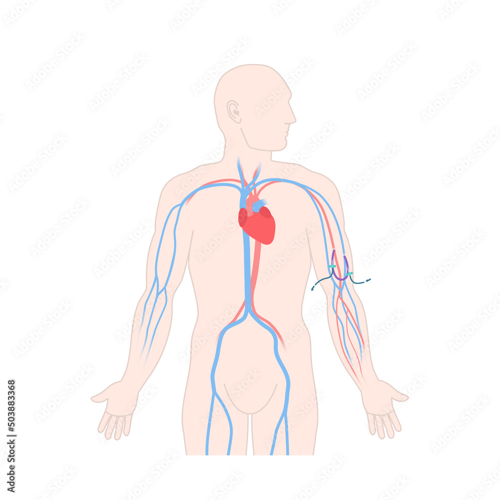 Arteriovenous dialysis shunt graft catheter for hemodialysis sessions