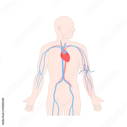 Arteriovenous dialysis shunt graft catheter for hemodialysis sessions. Man with surgically inserted tube connecting artery to vein under skin. Medical vector illustration. photo