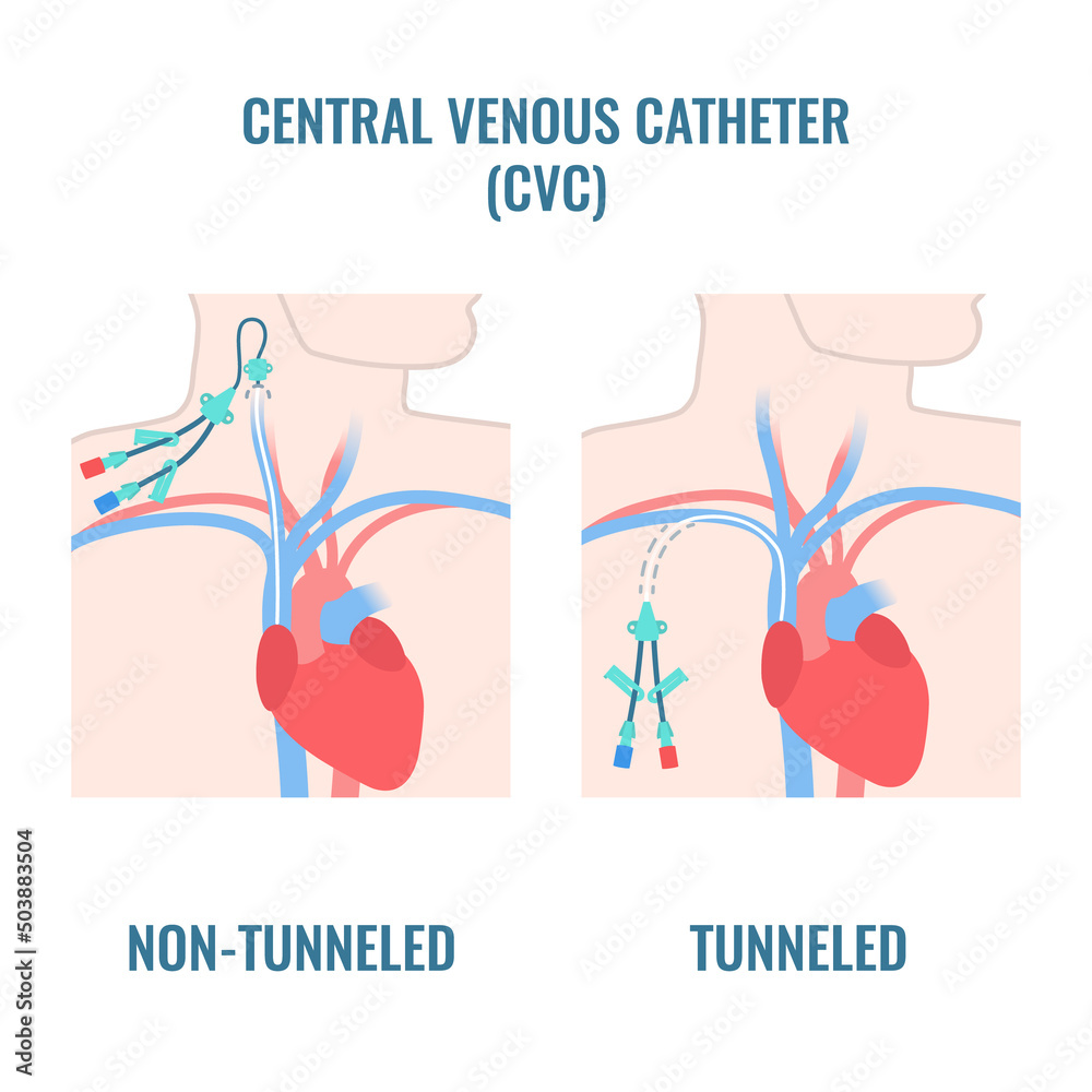 Internal Jugular Central Venous Catheter Close Up Stock Vector | Images ...