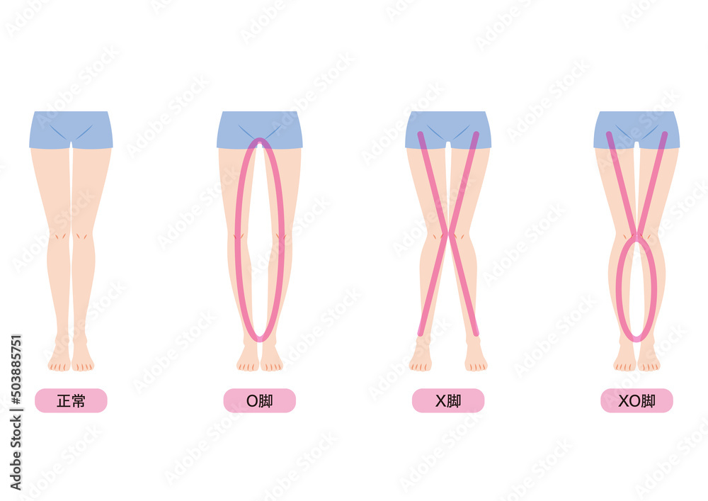 O脚・X脚・XO脚 O脚・X脚・XO脚