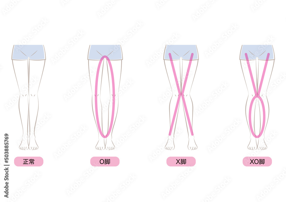 O脚・X脚・XO脚 O脚・X脚・XO脚