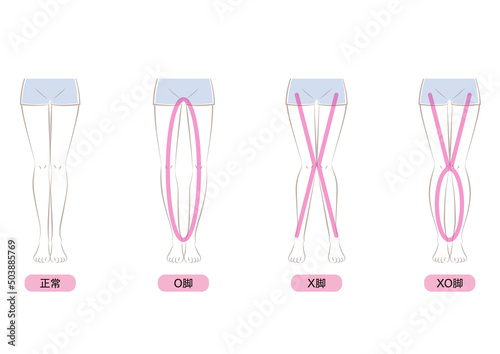 O脚・X脚・XO脚