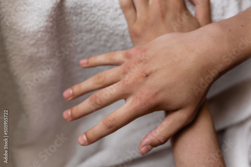 Dry hands of a guy with wounds. Weathered hands in a teenager. White background.