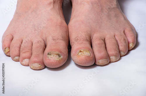 Toenails are affected by the fungus