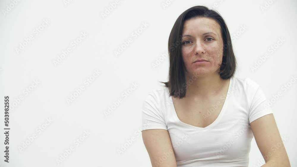 4k video of female face with skin problems. 4k video of female face with skin problems.