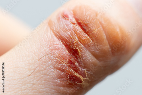 Chemical burn of a finger. Household burn. An open deep wound. Damaged epidermis. Regeneration process. Macro view.