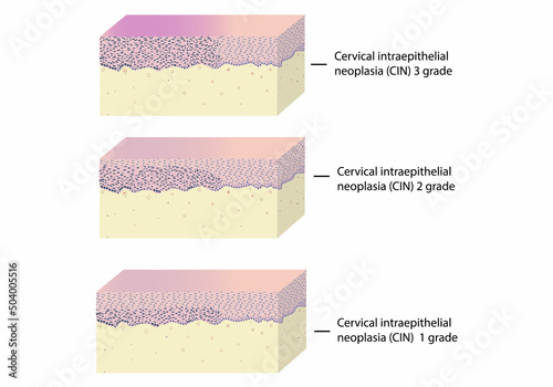 Histology of intraepithelial neoplasia of cervix uteri under a microscope, vector, illustration, set