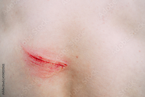 bloody wound on the back