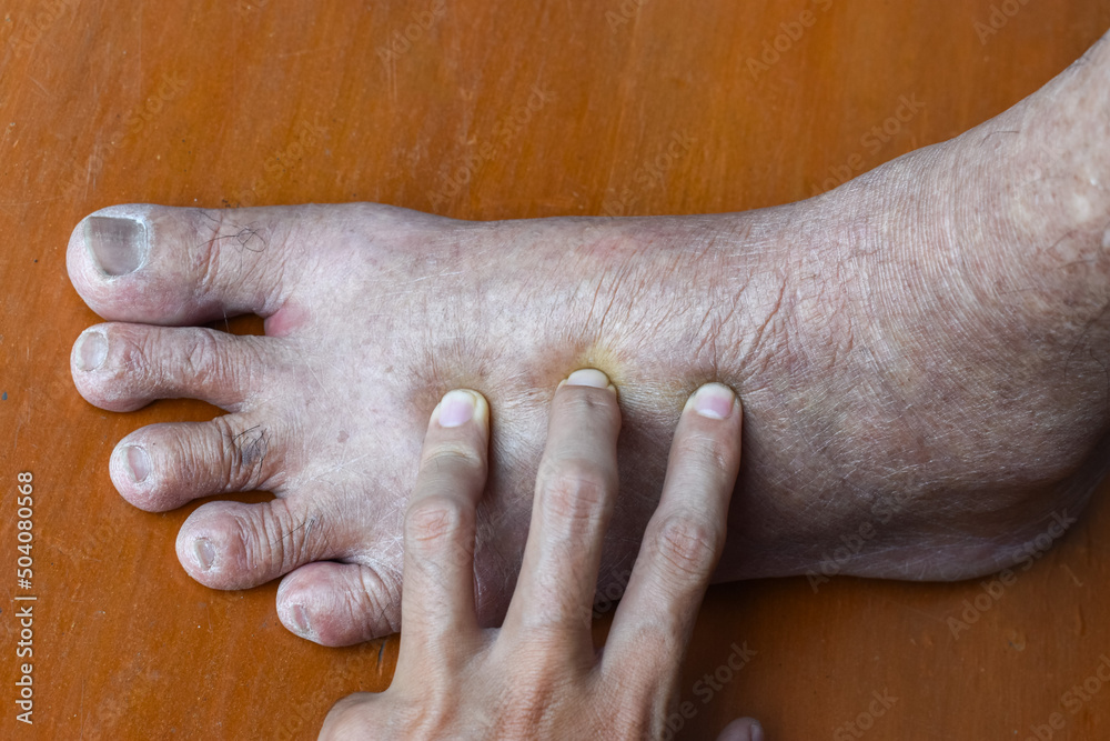 Pitting edema of lower limb. Swollen leg of Asian man. Stock Photo