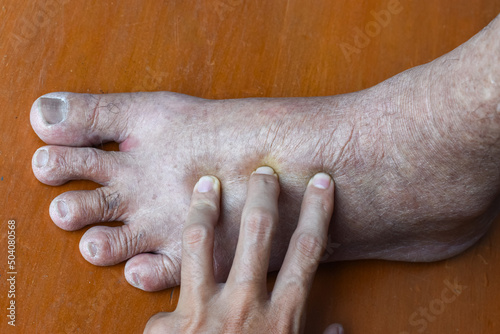 Pitting edema of lower limb. Swollen leg of Asian man. photo