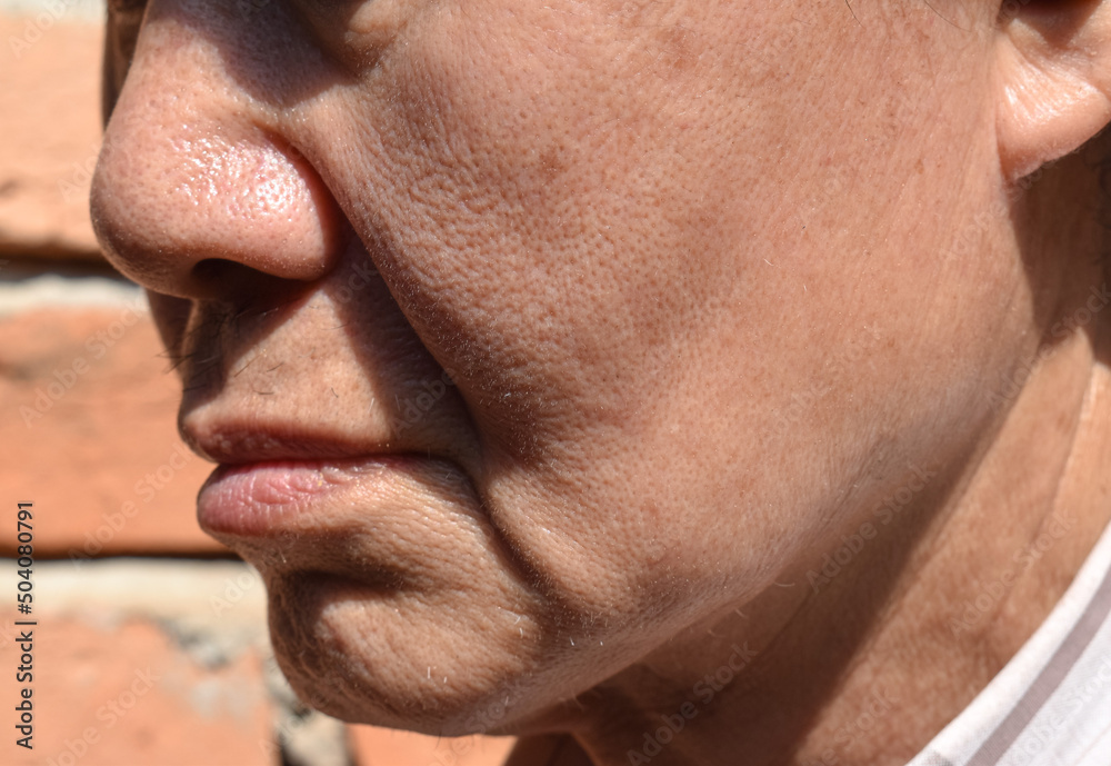 Enlarged pores in oily face of Asian, elder man with skin folds. Enlarged pores in oily face of Asian, elder man with skin folds.