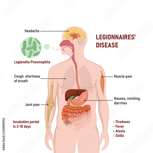 Legionnaires disease or legionellosis or Legion fever. Signs and symptoms is a form of atypical pneumonia. photo