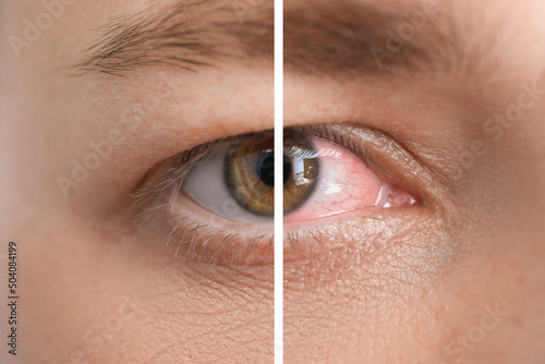 Canvastavla Closeup view of man before and after eye treatment