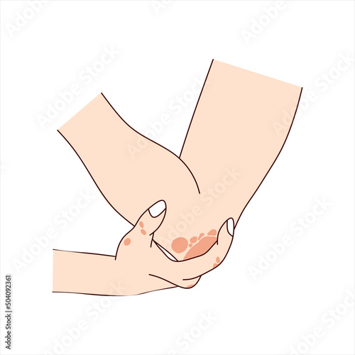 Hands and elbow with skin rashes psoriasis