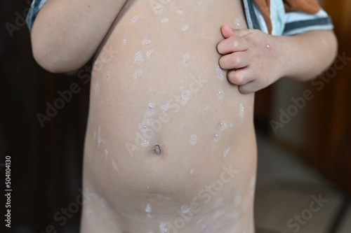 Young boy with varicella zoster virus. Closeup of skin with chickenpox bubble rash on child