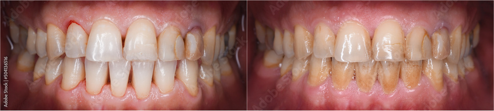 teeth calculus and tartar cleaning