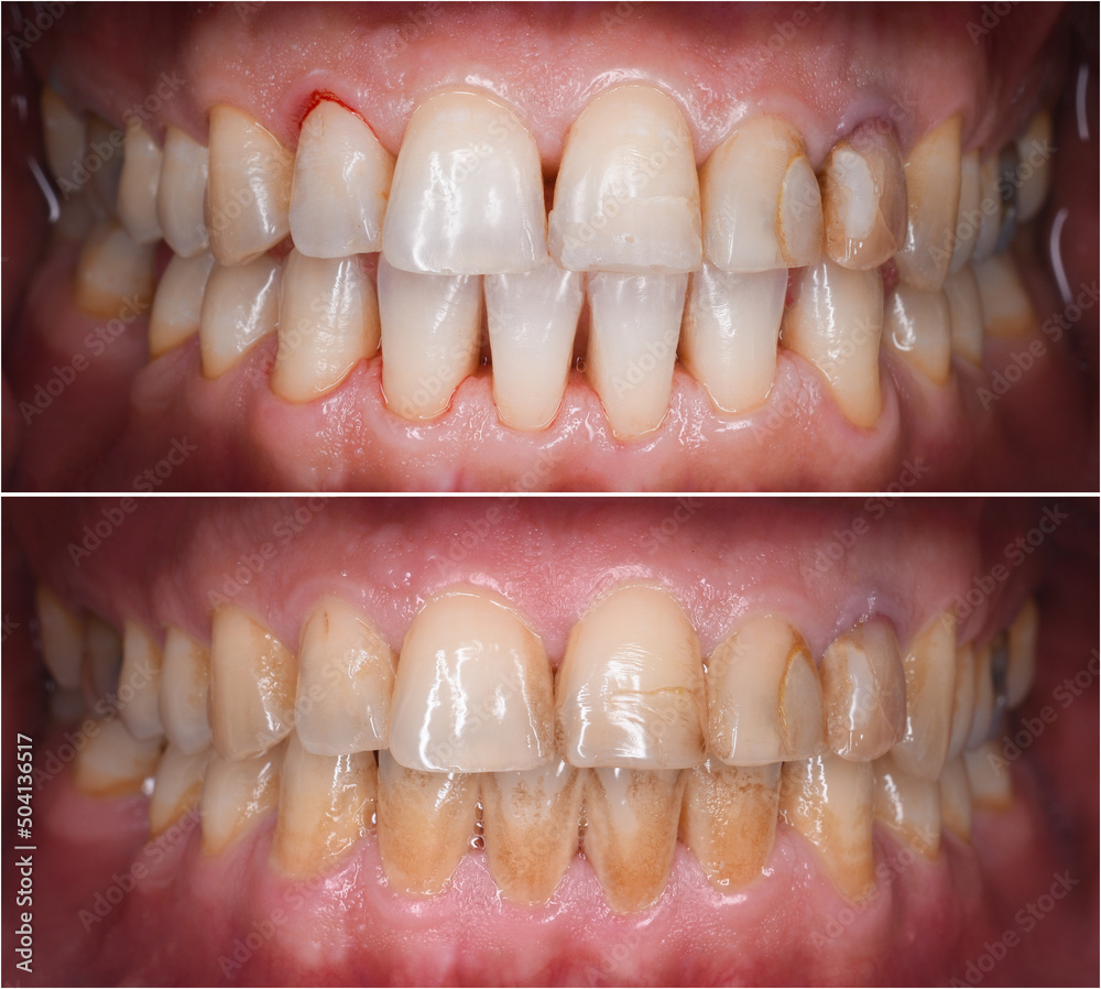 teeth calculus and tartar cleaning teeth calculus and tartar cleaning