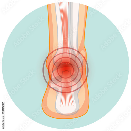 Achilles tendo rupture in circle template