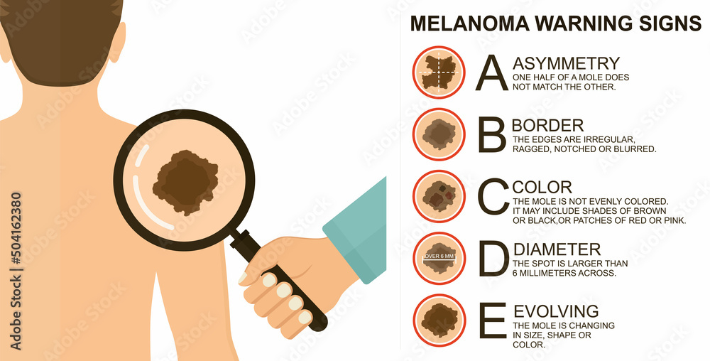 Diagnosis Of Skin Cancer Melanoma Warning Signs Dermatological