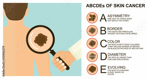 Diagnosis of skin cancer. Melanoma warning signs. Dermatological screening. UVB prevention of squamous cell treatment. Basal test. ABCDEs of skin cancer screening. Man back view

