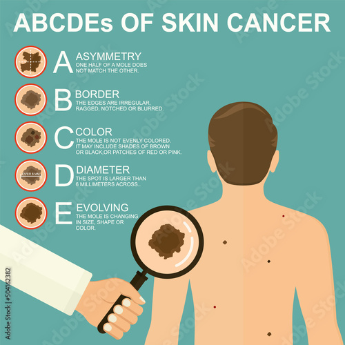 Diagnosis of skin cancer. Melanoma warning signs. Dermatological screening. UVB prevention of squamous cell treatment. Basal test. ABCDEs of skin cancer screening. Man back view
