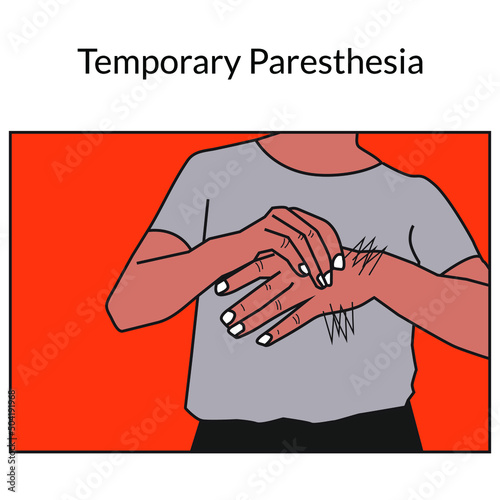Paresthesia stock illustration. The vector image relates to a burning or tingling sensation in the hands