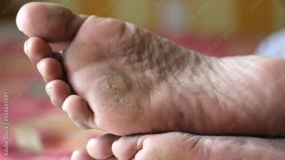close up of young men dry feet on bed , close up of young men dry feet on bed ,