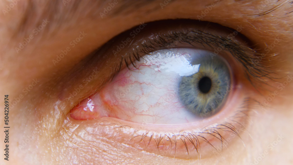Fototapeta premium A close-up of a man's blue eye looks away. There are red capillaries on the eyeball. A tired human eye after a day at the computer.