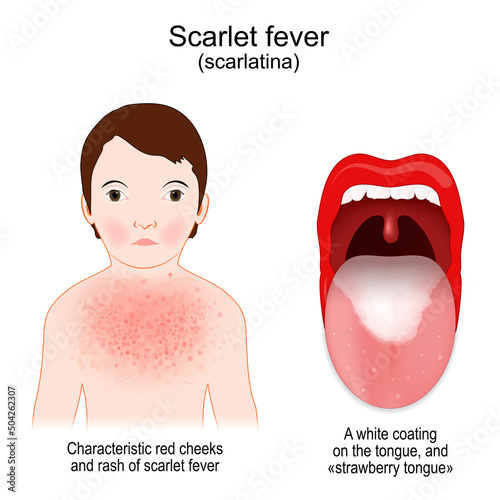 Scarlet fever