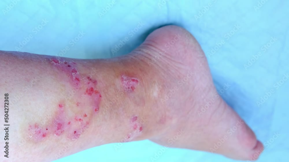 close-up of human shin, numerous wounds on leg of adult female patient, redness, scarring, sores from scratching, burn, concept of medical care, self-harm to skin, human tissue regeneration