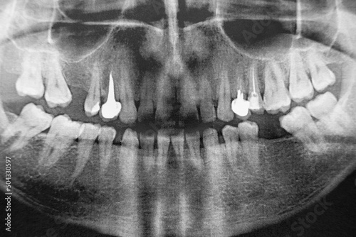 x-ray of a man's jaw 360 degrees. very high noise. two implants. Horizontal image.