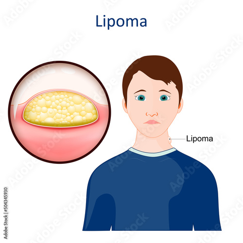 Lipoma. Skin disease