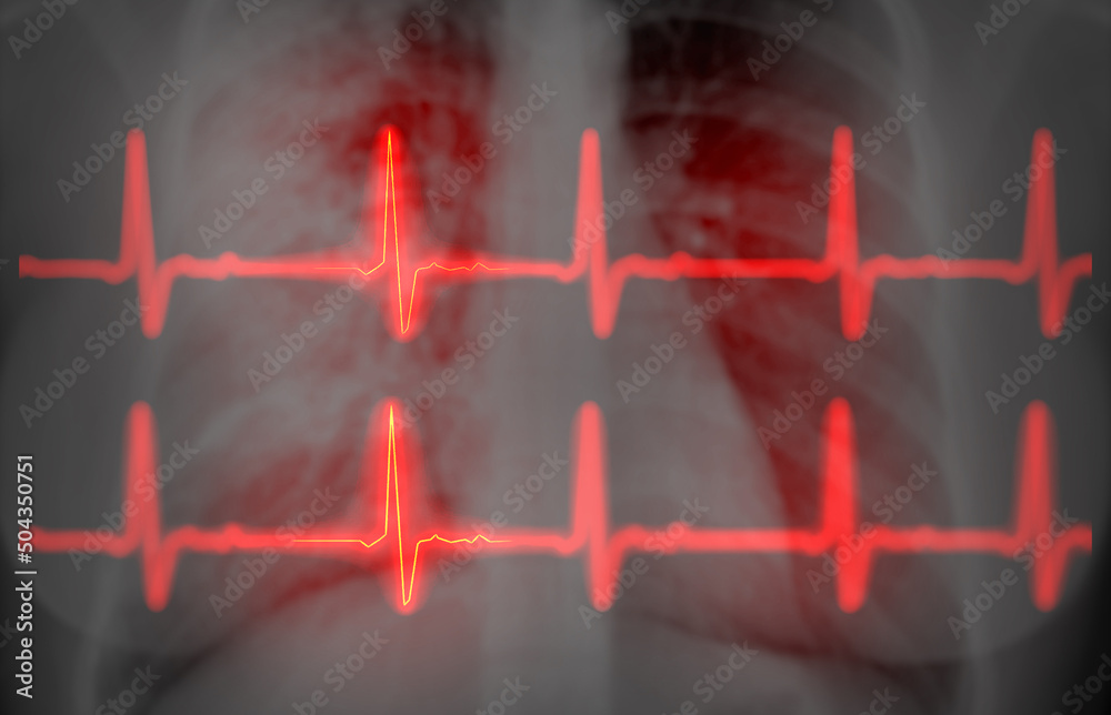 CHEST Xray with EKG 3D rendering image for diagnosis of vessel