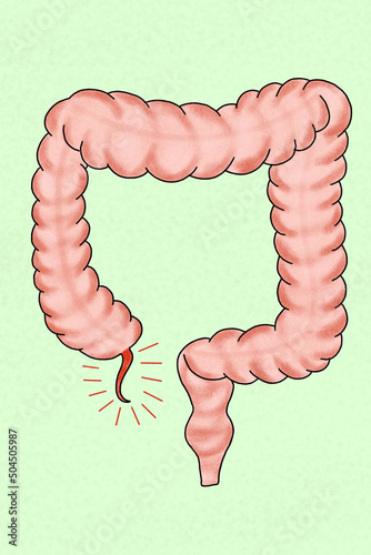 Picture of large intestine with appendicitis photo