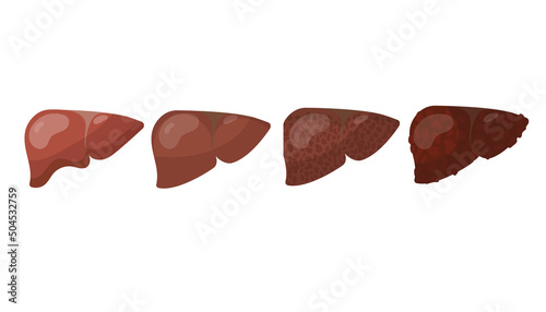 Stages of human liver destruction cartoon illustration set. Person having liver disease or cancer. Internal organ isolated on white background. Biology, health concept