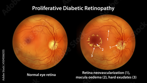 Diabetic retinopathy, ophthalmoscopic diagnosis, illustration photo