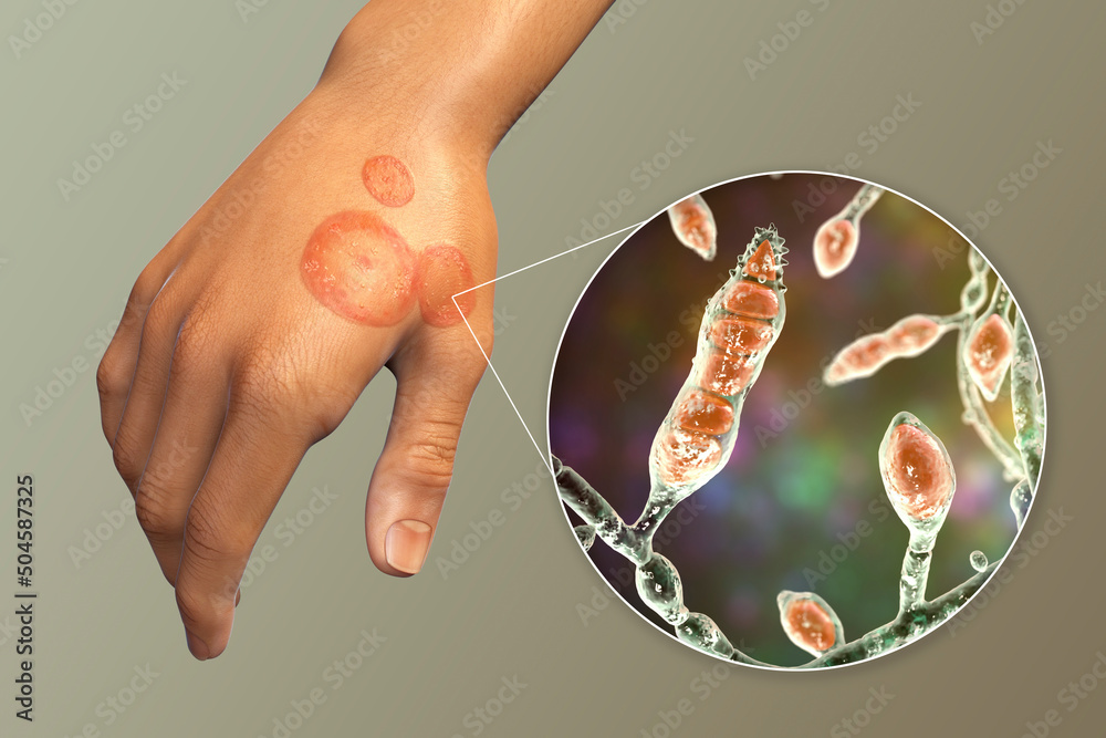 Fungal infection on a man's hand. Tinea manuum and close-up view of  dermatophyte fungi Stock Illustration