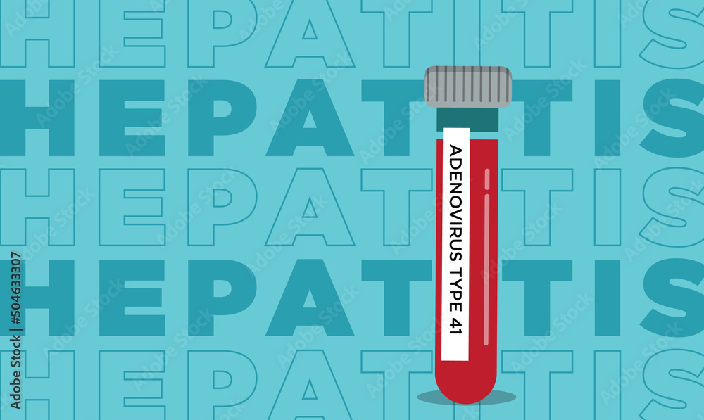 Hepatitis infantil. Tubo de muestra de sangre para la prueba de Adenovirus y PCR de ADN del Norovirus en el laboratorio médico. Para diagnosticar la infección viral.
