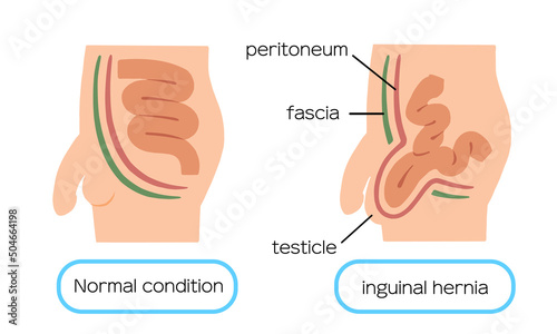 Male illness inguinal hernia illustration