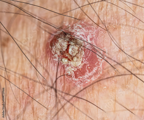 Basal cell or squamous cell carcinoma on sun exposed skin photo