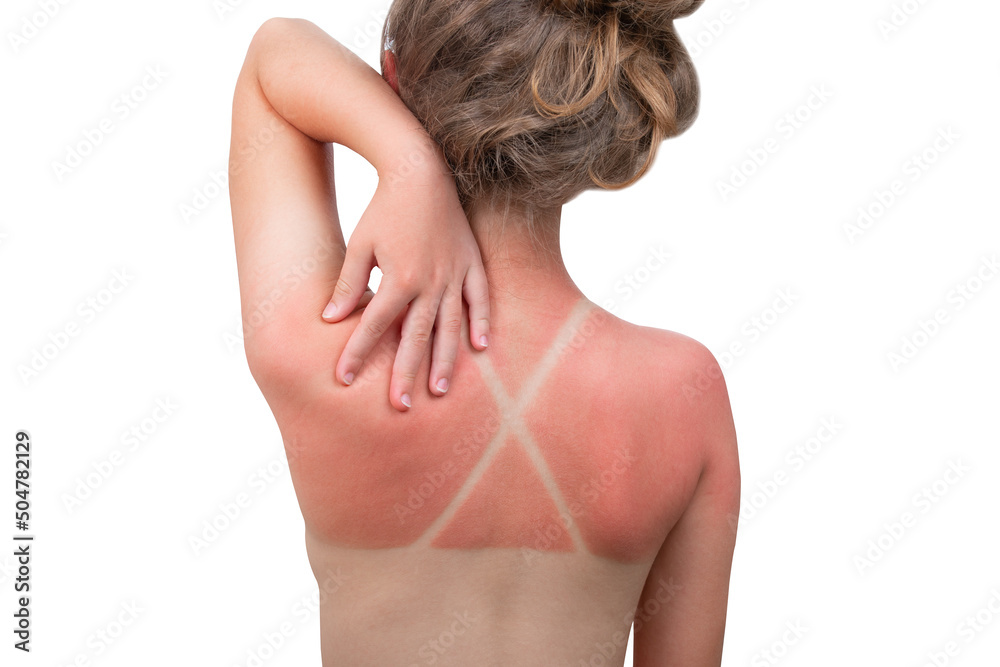 Sunburn. Girl got a Sunburn. Red painful skin on back that feels hot to the touch after beach visits. Use Sunscreen or UV protection cream. Summer vacation on ocean beach. White Isolated background. Sunburn. Girl got a Sunburn. Red painful skin on back that feels hot to the touch after beach visits. Use Sunscreen or UV protection cream. Summer vacation on ocean beach. White Isolated background.