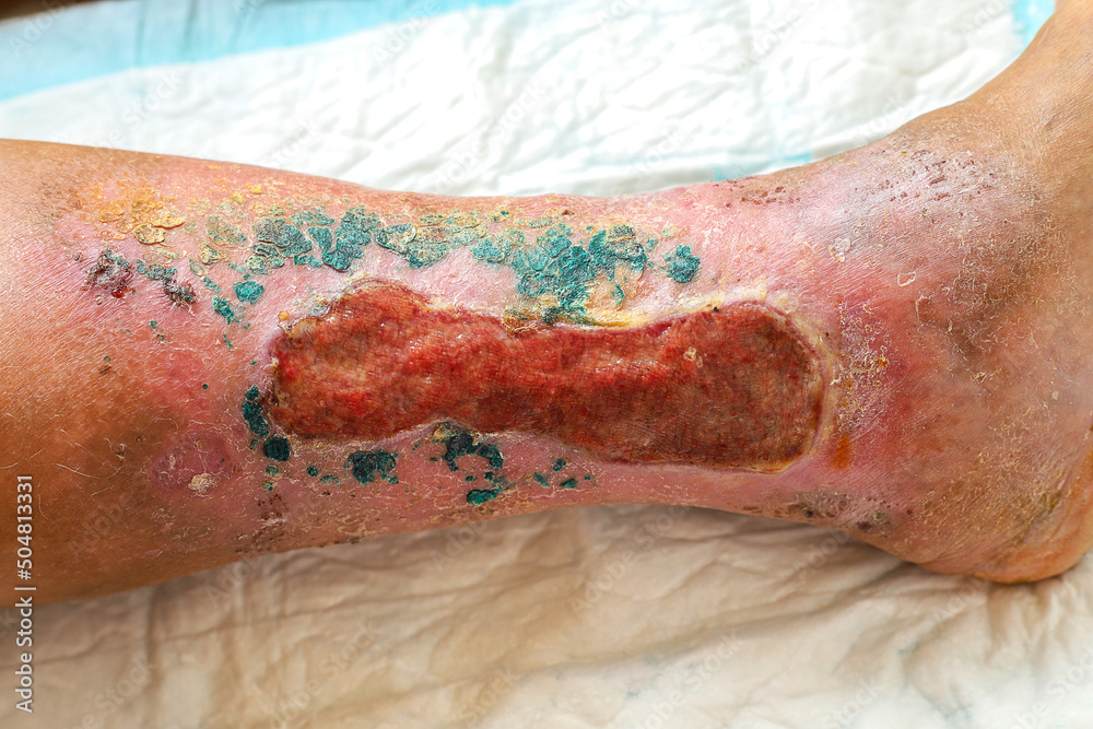 trophic ulcer of the skin in the lower leg in the granulation stage. - obrazy, fototapety, plakaty 