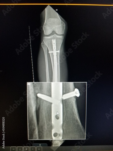 Right tibial fracture with broken internal fixation hardware