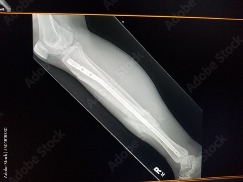 Right tibial fracture with internal fixation hardware